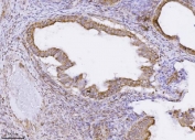 IHC staining of FFPE human ovarian carcinoma tissue with PMPCB antibody. HIER: boil tissue sections in pH8 EDTA for 20 min and allow to cool before testing.