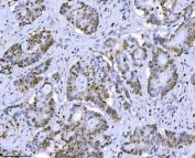 IHC staining of FFPE human adenocarcinoma of the colon tissue with MCM7 antibody. HIER: boil tissue sections in pH8 EDTA for 20 min and allow to cool before testing.