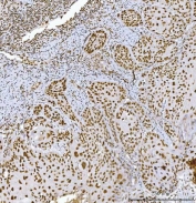 IHC staining of FFPE human squamous cell lung carcinoma tissue with RCC1 antibody. HIER: boil tissue sections in pH8 EDTA for 20 min and allow to cool before testing.