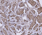 IHC staining of FFPE human breast cancer tissue with RCC1 antibody. HIER: boil tissue sections in pH8 EDTA for 20 min and allow to cool before testing.