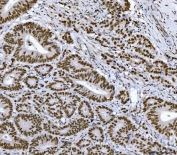 IHC staining of FFPE human colorectal adenocarcinoma tissue with RCC1 antibody. HIER: boil tissue sections in pH8 EDTA for 20 min and allow to cool before testing.