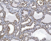 IHC staining of FFPE human thyroiditis tissue with RCC1 antibody. HIER: boil tissue sections in pH8 EDTA for 20 min and allow to cool before testing.