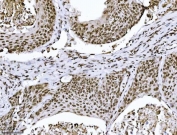 IHC staining of FFPE human squamous cell lung carcinoma tissue with KPNB1 antibody. HIER: boil tissue sections in pH8 EDTA for 20 min and allow to cool before testing.