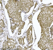 IHC staining of FFPE human breast cancer tissue with KPNB1 antibody. HIER: boil tissue sections in pH8 EDTA for 20 min and allow to cool before testing.