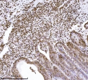 IHC staining of FFPE human colorectal adenocarcinoma tissue with KPNB1 antibody. HIER: boil tissue sections in pH8 EDTA for 20 min and allow to cool before testing.