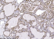 IHC staining of FFPE human thyroiditis tissue with KPNB1 antibody. HIER: boil tissue sections in pH8 EDTA for 20 min and allow to cool before testing.