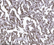 IHC staining of FFPE human renal carcinoma tissue with KPNB1 antibody. HIER: boil tissue sections in pH8 EDTA for 20 min and allow to cool before testing.