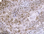 IHC staining of FFPE human laryngeal squamous cell carcinoma tissue with KPNB1 antibody. HIER: boil tissue sections in pH8 EDTA for 20 min and allow to cool before testing.