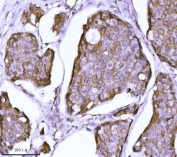 IHC staining of FFPE human breast cancer tissue with Catenin delta 1 antibody. HIER: boil tissue sections in pH8 EDTA for 20 min and allow to cool before testing.