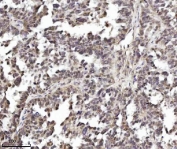 IHC staining of FFPE human ovarian serous tumor tissue with TRIM24 antibody. HIER: boil tissue sections in pH8 EDTA for 20 min and allow to cool before testing.