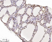 IHC staining of FFPE human thyroid cancer tissue with TRIM24 antibody. HIER: boil tissue sections in pH8 EDTA for 20 min and allow to cool before testing.