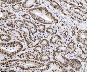 IHC staining of FFPE human adenocarcinoma of the colon tissue with TRIM24 antibody. HIER: boil tissue sections in pH8 EDTA for 20 min and allow to cool before testing.