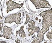 IHC staining of FFPE human breast cancer tissue with TRIM24 antibody. HIER: boil tissue sections in pH8 EDTA for 20 min and allow to cool before testing.