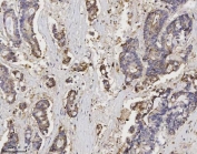 IHC staining of FFPE human adenocarcinoma of the colon tissue with ANXA3 antibody. HIER: boil tissue sections in pH8 EDTA for 20 min and allow to cool before testing.