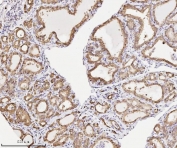 IHC staining of FFPE human thyroid cancer tissue with ANXA3 antibody. HIER: boil tissue sections in pH8 EDTA for 20 min and allow to cool before testing.