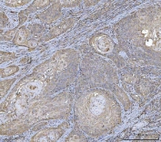 IHC staining of FFPE human laryngeal squamous cell carcinoma tissue with HLA-DRA antibody. HIER: boil tissue sections in pH8 EDTA for 20 min and allow to cool before testing.