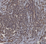 IHC staining of FFPE human infiltrating breast cancer tissue with HLA-DRA antibody. HIER: boil tissue sections in pH8 EDTA for 20 min and allow to cool before testing.