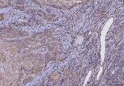 IHC staining of FFPE human laryngeal squamous cell carcinoma tissue with HLA-DRA antibody. HIER: boil tissue sections in pH8 EDTA for 20 min and allow to cool before testing.