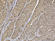 IHC staining of FFPE human hepatocellular carcinoma tissue with Ataxin 1 antibody. HIER: boil tissue sections in pH8 EDTA for 20 min and allow to cool before testing.