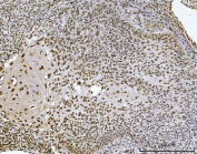 IHC staining of FFPE human laryngeal squamous cell carcinoma tissue with Ataxin 1 antibody. HIER: boil tissue sections in pH8 EDTA for 20 min and allow to cool before testing.