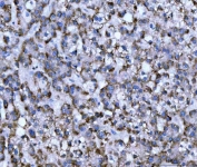 IHC staining of FFPE human liver cancer tissue with WD repeat-containing protein 1 antibody. HIER: boil tissue sections in pH8 EDTA for 20 min and allow to cool before testing.