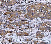 IHC staining of FFPE human colorectal adenocarcinoma tissue with WD repeat-containing protein 1 antibody. HIER: boil tissue sections in pH8 EDTA for 20 min and allow to cool before testing.
