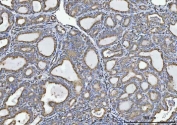 IHC staining of FFPE human thyroiditis tissue with GLDC antibody. HIER: boil tissue sections in pH8 EDTA for 20 min and allow to cool before testing.