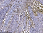 IHC staining of FFPE human squamous cell lung carcinoma tissue with Integrin linked ILK antibody. HIER: boil tissue sections in pH8 EDTA for 20 min and allow to cool before testing.