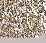 IHC staining of FFPE human liver cancer tissue with ALYREF antibody, HRP-secondary and DAB substrate. HIER: boil tissue sections in pH8 EDTA for 20 min and allow to cool before testing.