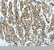 IHC staining of FFPE human liver cancer tissue with ALYREF antibody, HRP-secondary and DAB substrate. HIER: boil tissue sections in pH8 EDTA for 20 min and allow to cool before testing.