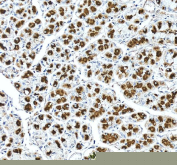 IHC staining of FFPE human stomach cancer tissue with ATP4A antibody, HRP-secondary and DAB substrate. HIER: boil tissue sections in pH8 EDTA for 20 min and allow to cool before testing.