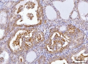 IHC staining of FFPE human thyroid cancer tissue with AXIN2 antibody. HIER: boil tissue sections in pH8 EDTA for 20 min and allow to cool before testing.