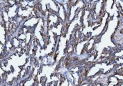 IHC staining of FFPE human renal carcinoma tissue with AXIN2 antibody. HIER: boil tissue sections in pH8 EDTA for 20 min and allow to cool before testing.