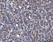 IHC staining of FFPE human liver cancer tissue with BBS9 antibody. HIER: boil tissue sections in pH8 EDTA for 20 min and allow to cool before testing.