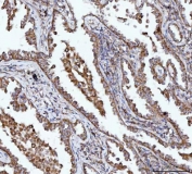 IHC staining of FFPE human lung cancer tissue with BBS9 antibody. HIER: boil tissue sections in pH8 EDTA for 20 min and allow to cool before testing.