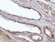 IHC staining of FFPE human prostate cancer tissue with BBS9 antibody. HIER: boil tissue sections in pH8 EDTA for 20 min and allow to cool before testing.