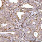 IHC staining of FFPE human rectal cancer tissue with BBS9 antibody. HIER: boil tissue sections in pH8 EDTA for 20 min and allow to cool before testing.