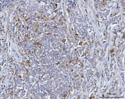 IHC staining of FFPE human lymphoma tissue with BCAT1 antibody. HIER: boil tissue sections in pH8 EDTA for 20 min and allow to cool before testing.