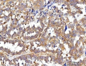 IHC staining of FFPE human ovarian cancer tissue with CCDC115 antibody. HIER: boil tissue sections in pH8 EDTA for 20 min and allow to cool before testing.