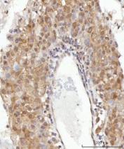 IHC staining of FFPE human liver cancer tissue with CEP250 antibody. HIER: boil tissue sections in pH8 EDTA for 20 min and allow to cool before testing.