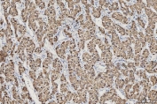 IHC staining of FFPE human liver cancer tissue with CES2 antibody. HIER: boil tissue sections in pH8 EDTA for 20 min and allow to cool before testing.