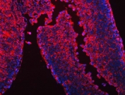 Immunofluorescent staining of FFPE human liver cancer tissue with CES2 antibody (red) and DAPI nuclear stain (blue). HIER: boil tissue sections in pH8 EDTA for 20 min and allow to cool before testing.