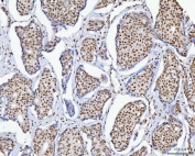 IHC staining of FFPE human breast cancer tissue with CHTOP antibody. HIER: boil tissue sections in pH8 EDTA for 20 min and allow to cool before testing.