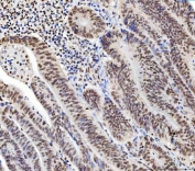 IHC staining of FFPE human colorectal adenocarcinoma tissue with CHTOP antibody. HIER: boil tissue sections in pH8 EDTA for 20 min and allow to cool before testing.