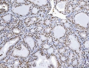 IHC staining of FFPE human thyroid cancer tissue with CHTOP antibody. HIER: boil tissue sections in pH8 EDTA for 20 min and allow to cool before testing.