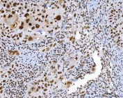 IHC staining of FFPE human laryngeal squamous cell carcinoma tissue with CHTOP antibody. HIER: boil tissue sections in pH8 EDTA for 20 min and allow to cool before testing.