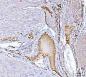IHC staining of FFPE human endometrial cancer tissue with Clusterin antibody. HIER: boil tissue sections in pH8 EDTA for 20 min and allow to cool before testing.