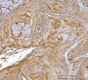 IHC staining of FFPE human laryngeal squamous cell carcinoma tissue with CRABP2 antibody. HIER: boil tissue sections in pH8 EDTA for 20 min and allow to cool before testing.