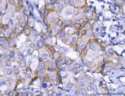 IHC staining of FFPE human breast cancer tissue with HER2 antibody. HIER: boil tissue sections in pH8 EDTA for 20 min and allow to cool before testing.