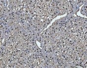 IHC staining of FFPE human liver cancer tissue with Fumarylacetoacetate hydrolase antibody. HIER: boil tissue sections in pH8 EDTA for 20 min and allow to cool before testing.